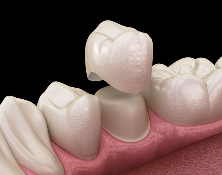Dental Tooth Crown