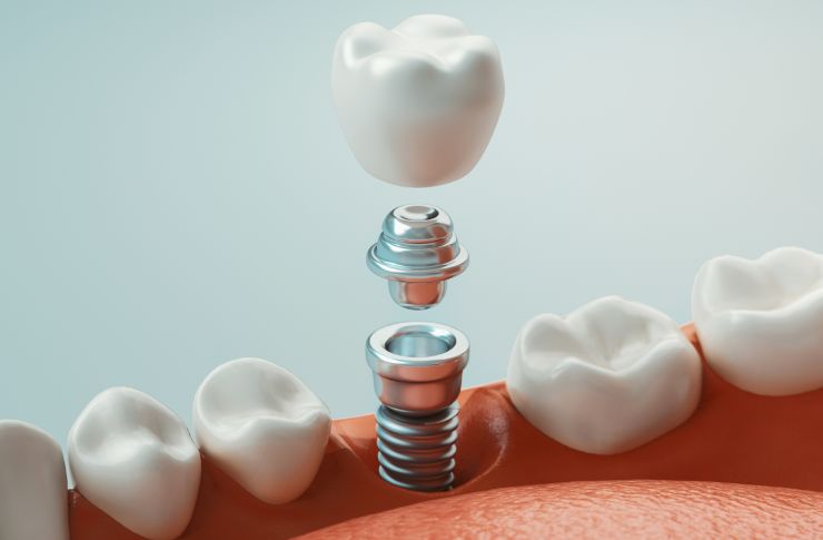 Dental Implant Vancouver