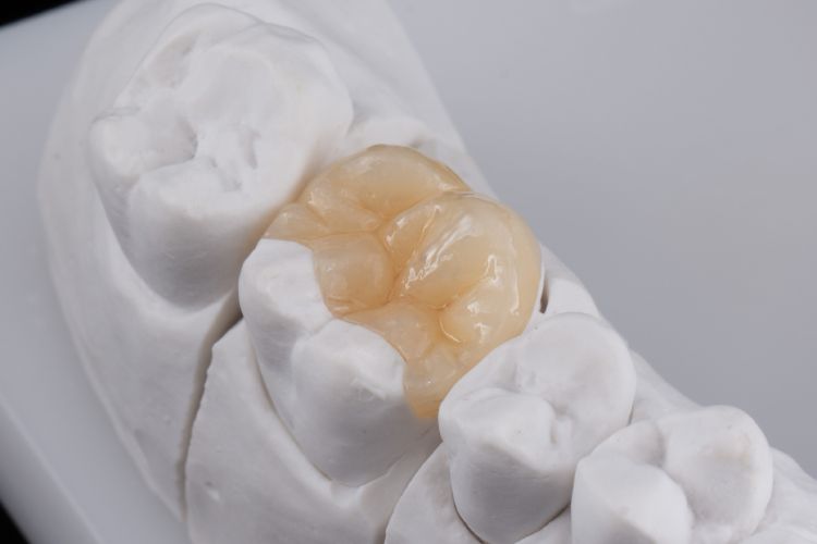 Teeth Inlays and Onlays