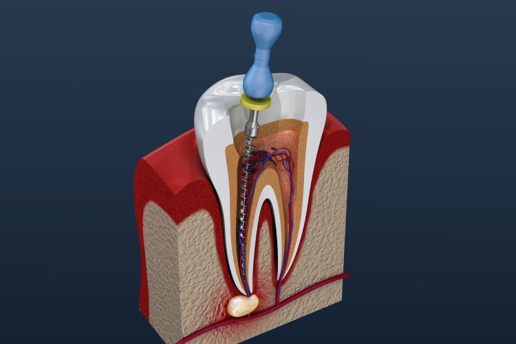 Root Canal Vancouver