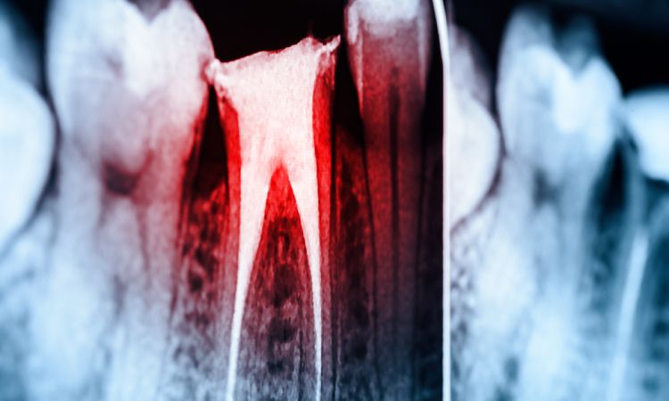 Root Canals and Tooth Extraction