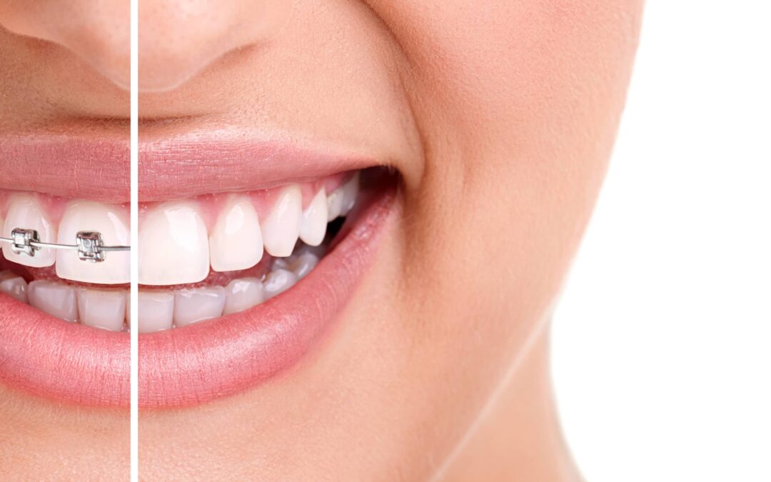 Orthodontics in Vancouver